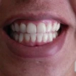 Smile Brilliant Professional Teeth Whitening: Review & Giveaway!